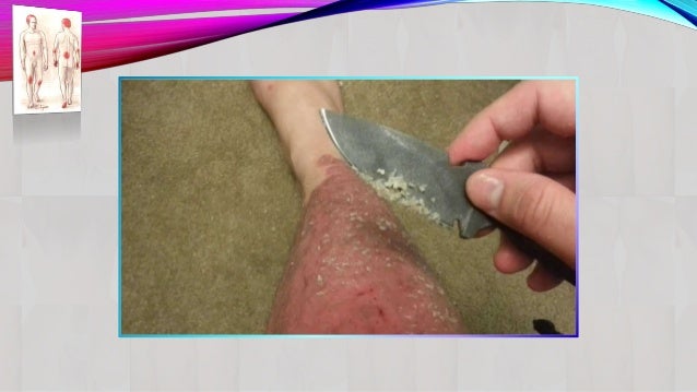 burst red capillaries on penis Burst red capillaries on penis